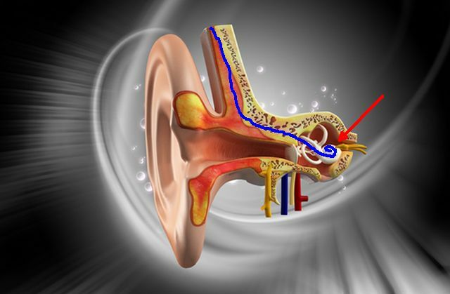 cohlear-implant2